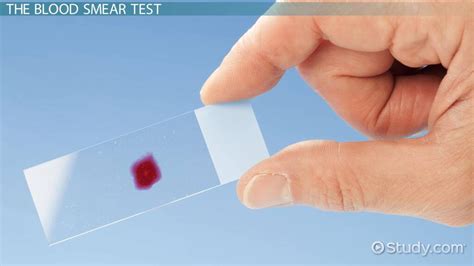 Blood Smear Test | Procedure & Possible Results - Lesson | Study.com