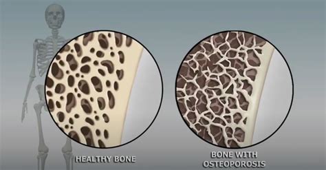 Bone density - ladegapt