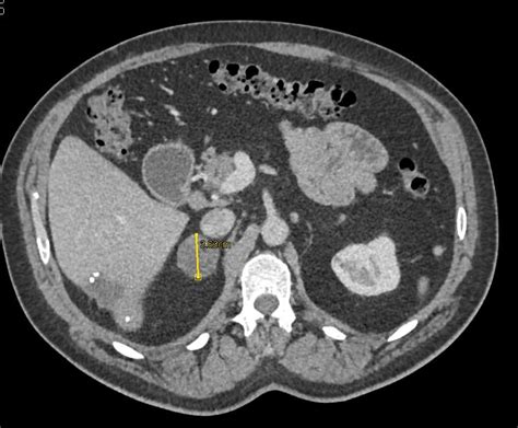 Right Adrenal Adenoma - Adrenal Case Studies - CTisus CT Scanning