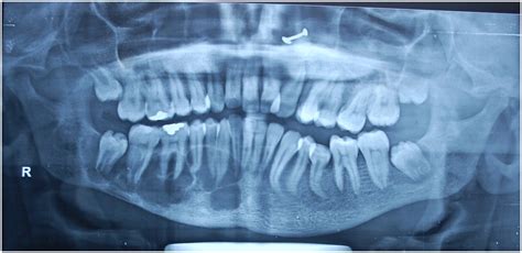 Traumatic bone cyst of the mandible in Langer-Giedion syndrome: a case report | Journal of ...