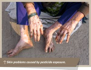 Agricultural Pesticides and Human Health