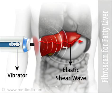 Liver Fibroscan Chart: A Visual Reference of Charts | Chart Master