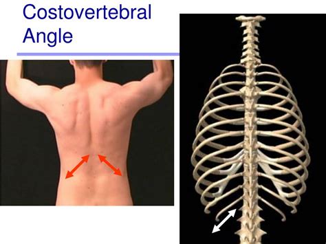 Costovertebral Angle