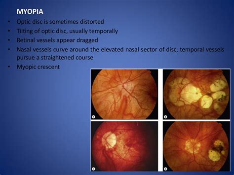 Optic disc evaluation