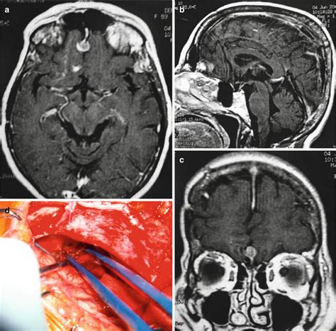 Olfactory Groove Meningiomas: Pitfalls and Surgical Technique | Neupsy Key