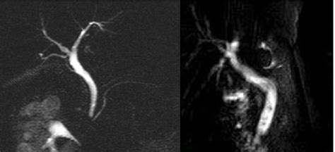 Normal appearance of ductus choledochus on MRCP after cholecystectomy... | Download Scientific ...