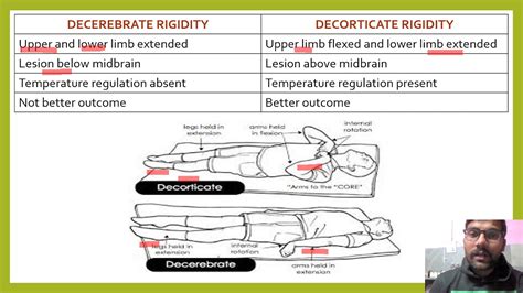 Decerebrate Rigidity