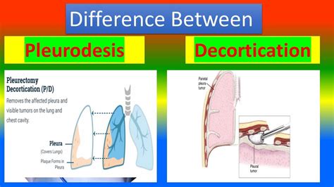 Difference between Pleurodesis and Decortication - YouTube