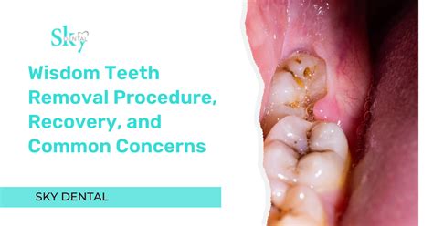 Wisdom Teeth Removal Procedure, Recovery, and Common Concerns