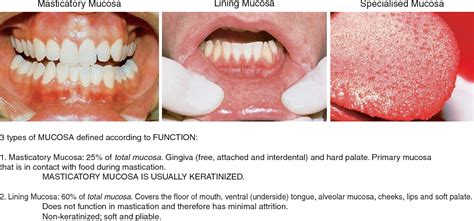 Common Oral Lesions Buccal Mucosa