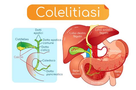 tájékoztat Ismerik szétzúz dieta ipolipidica per calcoli alla ...