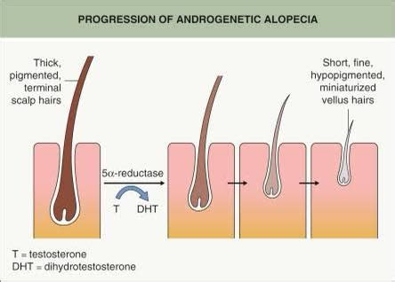 Understand the... - Hair Transplant Jaipur By Dr Kothiwala