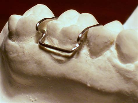 Dentistry and Medicine: Retention of removable Orthodontic appliences