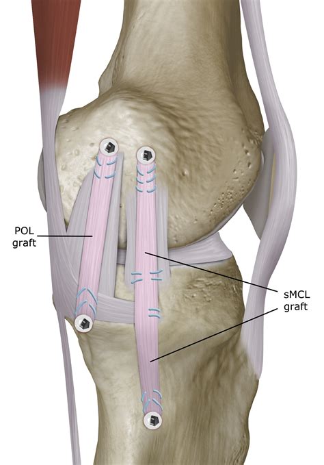 Surgical Techniques for the Reconstruction of Medial Collateral Ligament and Posteromedial ...