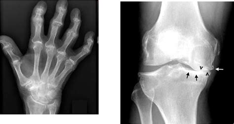 Dentistry and Medicine: Osteoarthritis