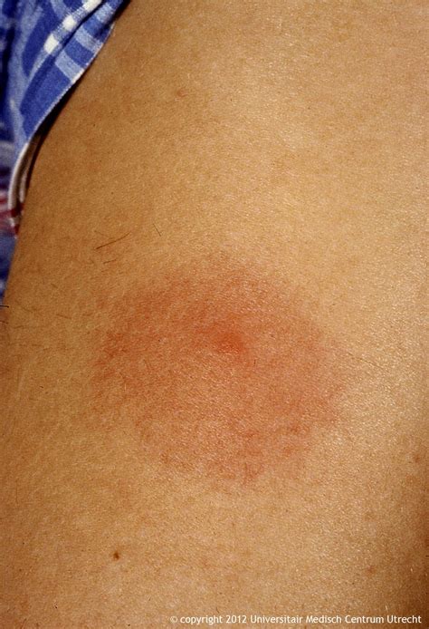 The characteristic bullseye rash for Lyme disease | Innatoss