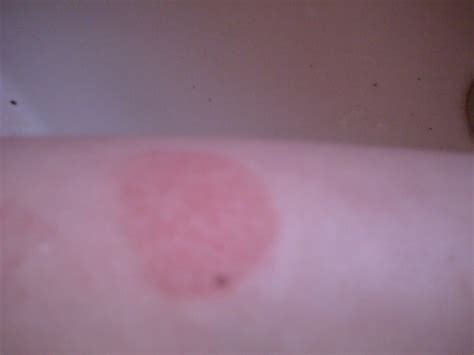 Diary of Lyme Girl: Congenital Lyme Re-occurring Bulls Eye Rash