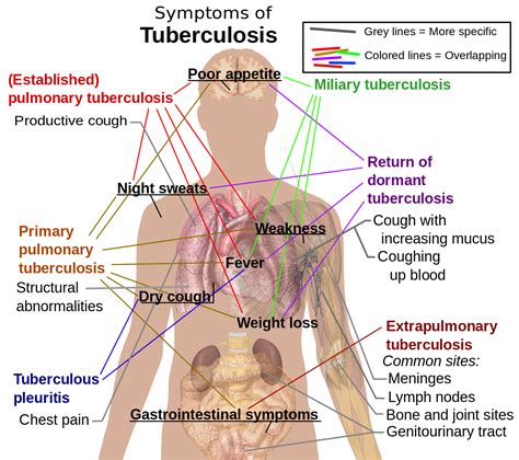 Tuberculosis – What are the signs and symptoms of TB? | Patient Talk