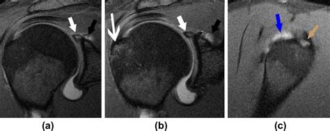 MRI Shoulder Impingement Syndrome