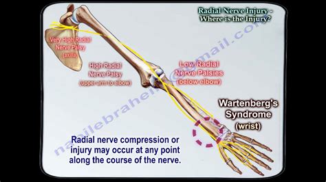 Radial Nerve Injury,Where Is The Injury - Everything You Need To Know - Dr. Nabil Ebraheim - YouTube