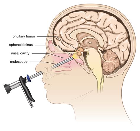 Pituitary Tumor Symptoms and Treatment - Goodman Campbell