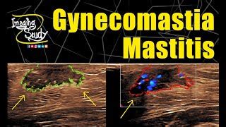 Gynecomastia with Mastitis || Ultrasound || Doppler || ... | Doovi