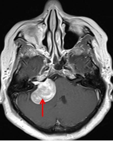 Vestibular Schwannoma – Radiology Cases