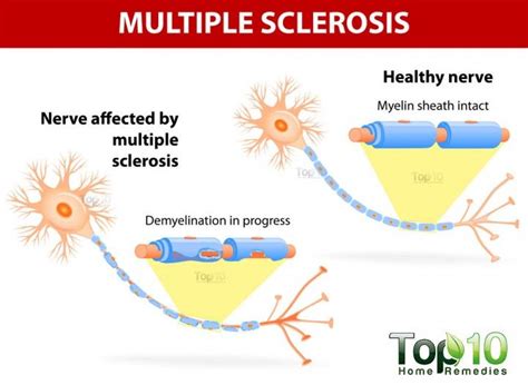 Pin on Multiple Sclerosis info