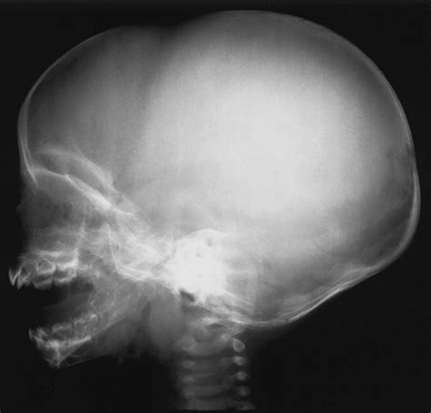 The Infant Skull: A Vault of Information | RadioGraphics