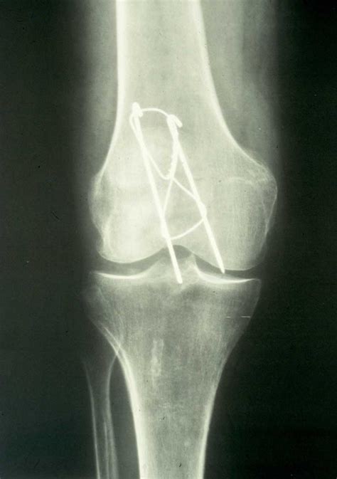 Sample Case Study 1 | The Tom Smallman Canadian Orthopaedic Association Basic Science Course