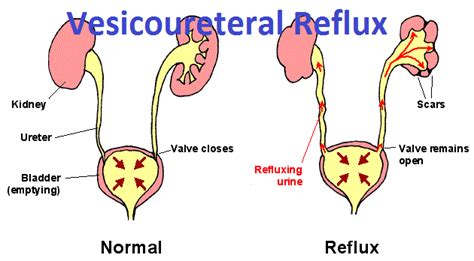 Vesicoureteral Reflux (VUR)