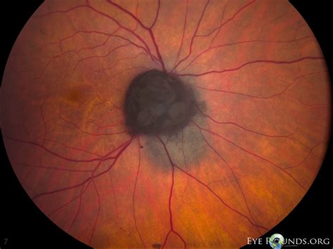 Atlas Entry - Melanocytoma with associated choroidal nevus