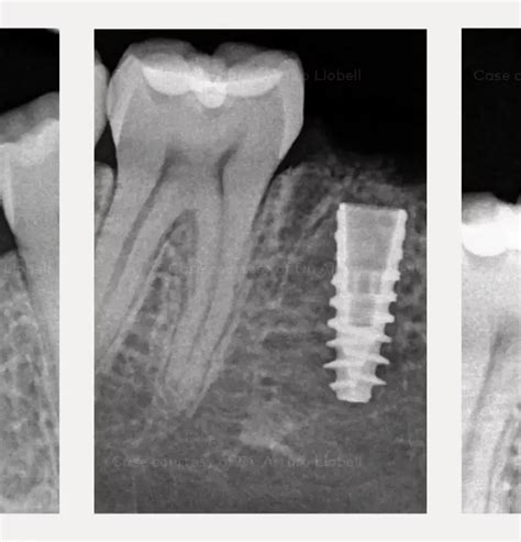 Loading of a Nobel Biocare N1 Implant for a lower molar