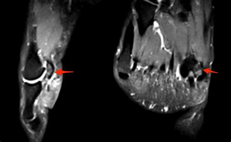 Bipartite Hallux Sesamoid Injury | coachingultrasound