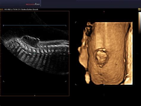 Spina bifida - defect of fetal`s development, 3D, echogramm №578