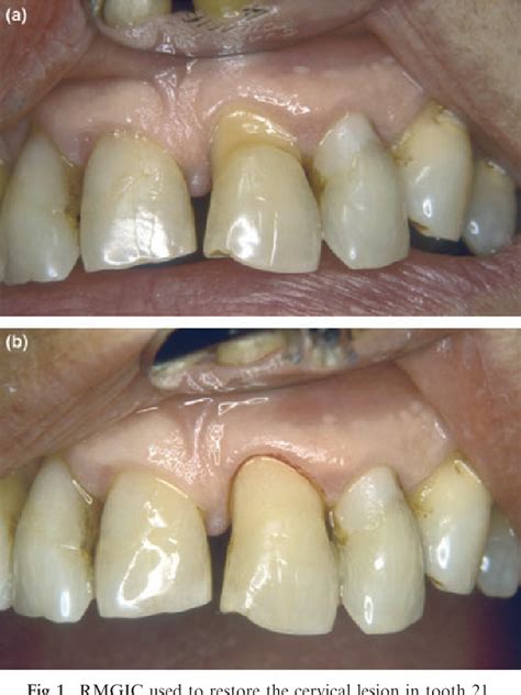 Glass-ionomer cement restorative materials: a sticky subject? | Semantic Scholar