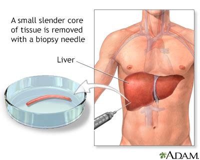 Liver biopsy Information | Mount Sinai - New York