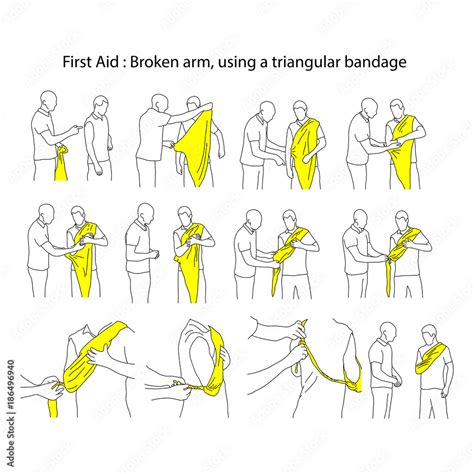 Broken arm using a triangular bandage vector illustration outline ...