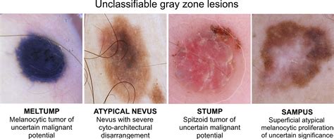 Junctional Melanocytic Nevus