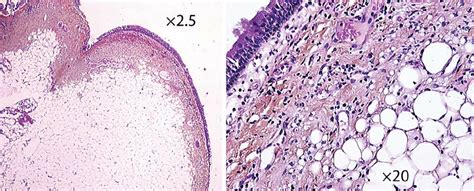 Histology of the lipoma at low and high magnification demonstrating the... | Download Scientific ...