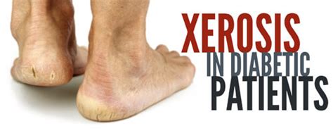 Dry Skin Alert: Foot Xerosis in Diabetic Patients | WCEI