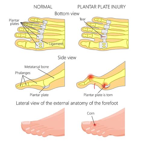 Podiatry Centre for Plantar Plate Tear in Singapore