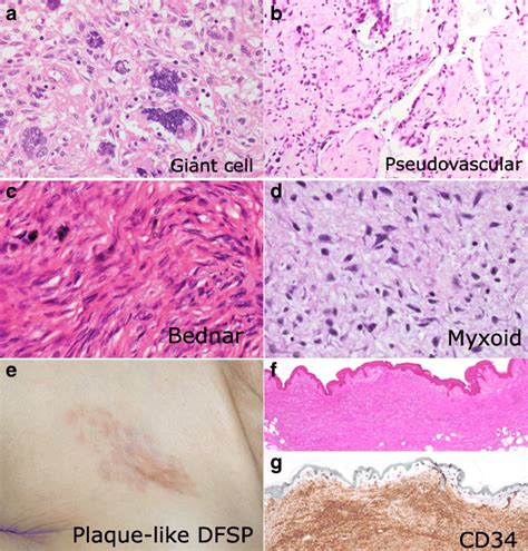 Dermatofibrosarcoma Protuberans Histology