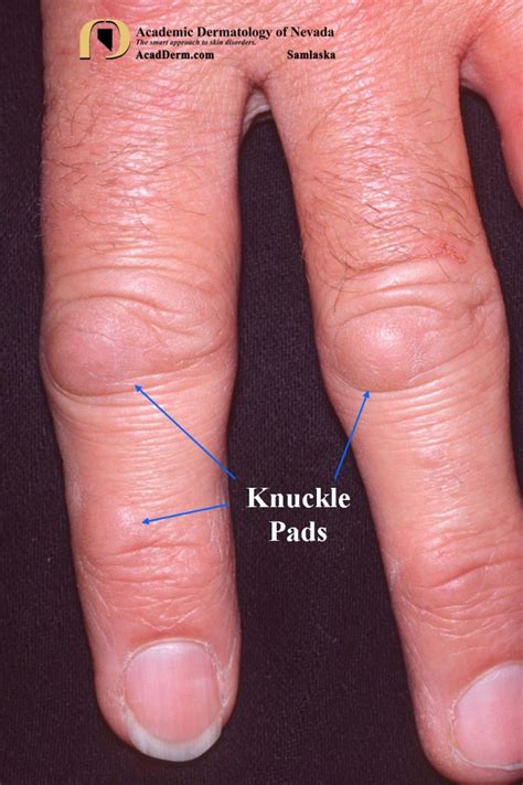 Knuckle Pads: Heloderma... - Academic Dermatology of Nevada