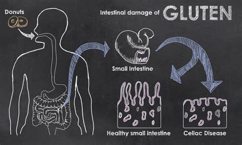 What is Celiac Disease?