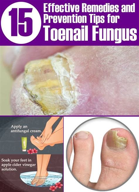 15 Natural Remedies & Prevention Tips for Toenail Fungus | Toenail ...