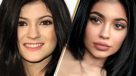 Kylie Jenner Before And After Plastic Surgery Photos