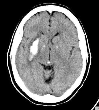 Putaminal Hemorrhage; Brain Hemorrhage, Putaminal; Hemorrhage, Putamen