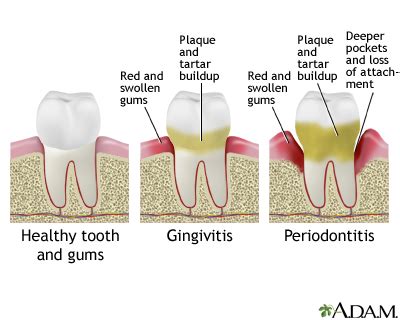 HIE Multimedia - Periodontitis