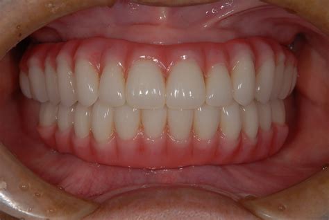 Pin on Overdentures